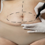 Op. Dr. Gökhan Semerci ile Karın Germe (Abdominoplasti) Uzmanlığı