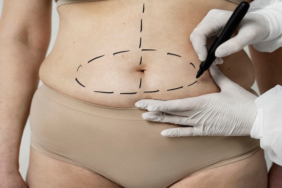 Op. Dr. Gökhan Semerci ile Karın Germe (Abdominoplasti) Uzmanlığı